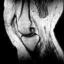 MRI Scan of my knee